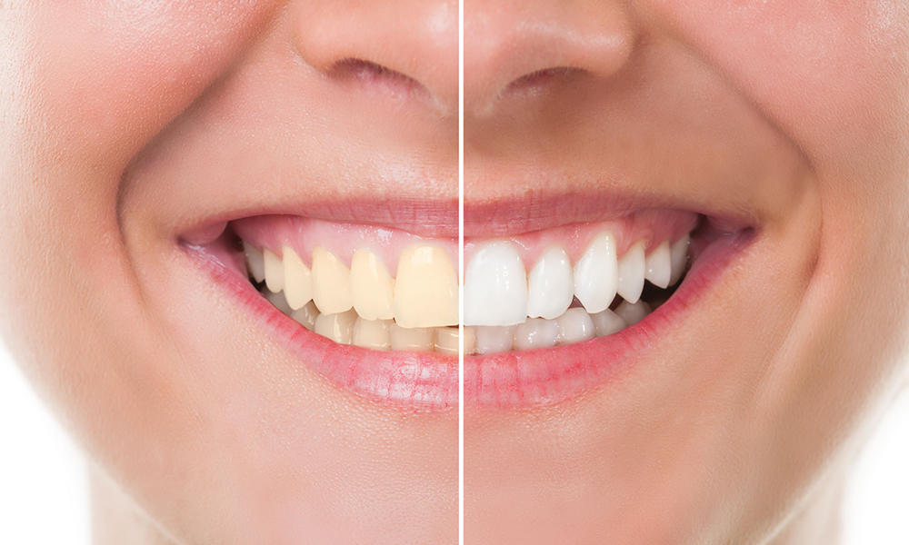 Before and after whitening